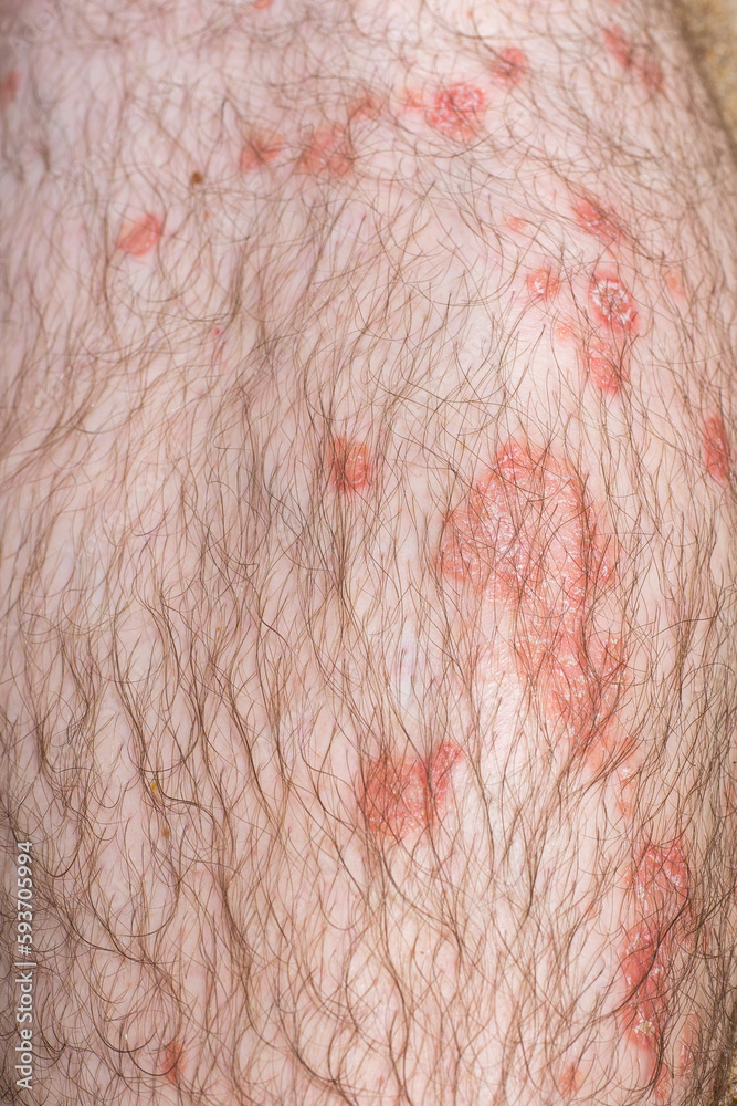 red scaly ulcers on the skin of a male leg. Immune disease psoriasis in