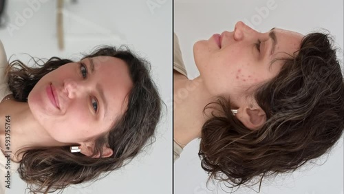 Vertical video. Two faces of young caucasian woman show real result before and after acne treatment. Split screen. Home background. Concept  of acne therapy, scars, inflammation on face, problem skin photo
