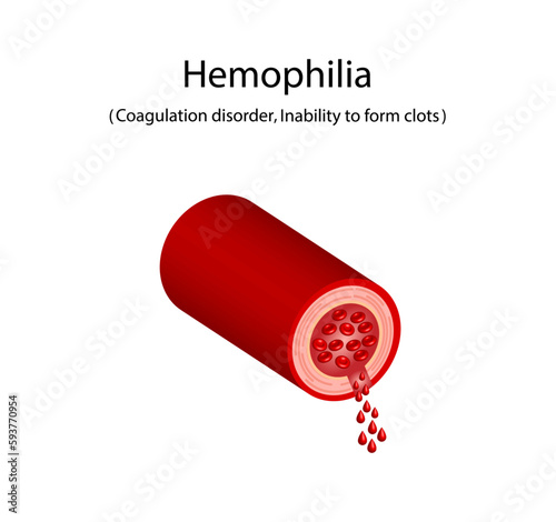 Hemophilia, a bleeding disorder that slows the blood clotting. Haemophilia (Coagulation disorder). Damaged blood vessel, hemorrhage. Healthy blood vessel after bleeding. Vector illustration.