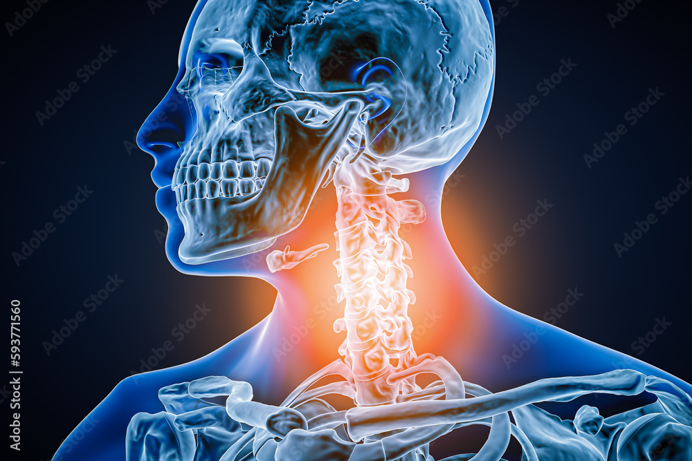 Cervical vertebrae with osteoarthritis, inflammation or injury 3D ...