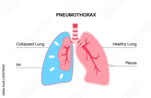 Pneumothorax anatomical poster