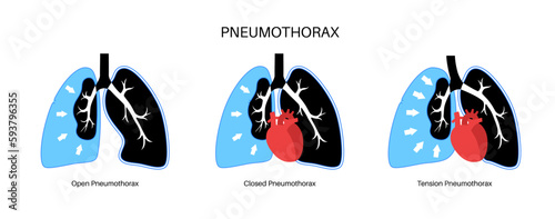 Pneumothorax anatomical poster