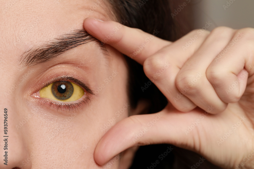 Woman with yellow eyes on blurred background, closeup. Symptom of hepatitis Woman with yellow eyes on blurred background, closeup. Symptom of hepatitis