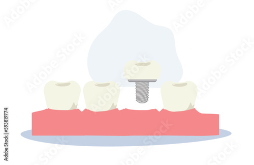 Dental medical concept. Tooth implant, Dental implant. Flat cartoon Vector illustration