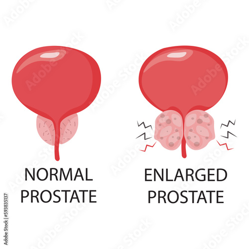 Normal prostate and benign pro-static hyperplasia. Bladder surgery urologist. Vector cartoon illustration 