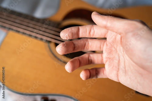 Guitarist's hand with peeling skin photo