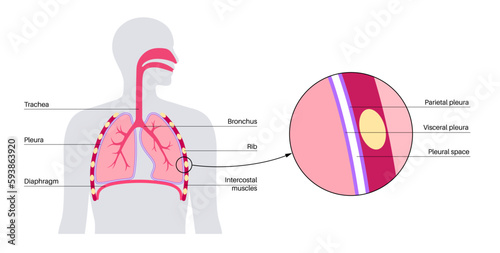 Pleura anatomical poster