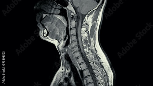 Magnetic Resonance images ( MRI ) of cervical spine sagittal. C5 ,C6, C7 injured disc disease photo