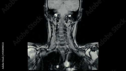 Magnetic Resonance images ( MRI ) of cervical spine sagittal. C5 ,C6, C7 injured disc disease photo