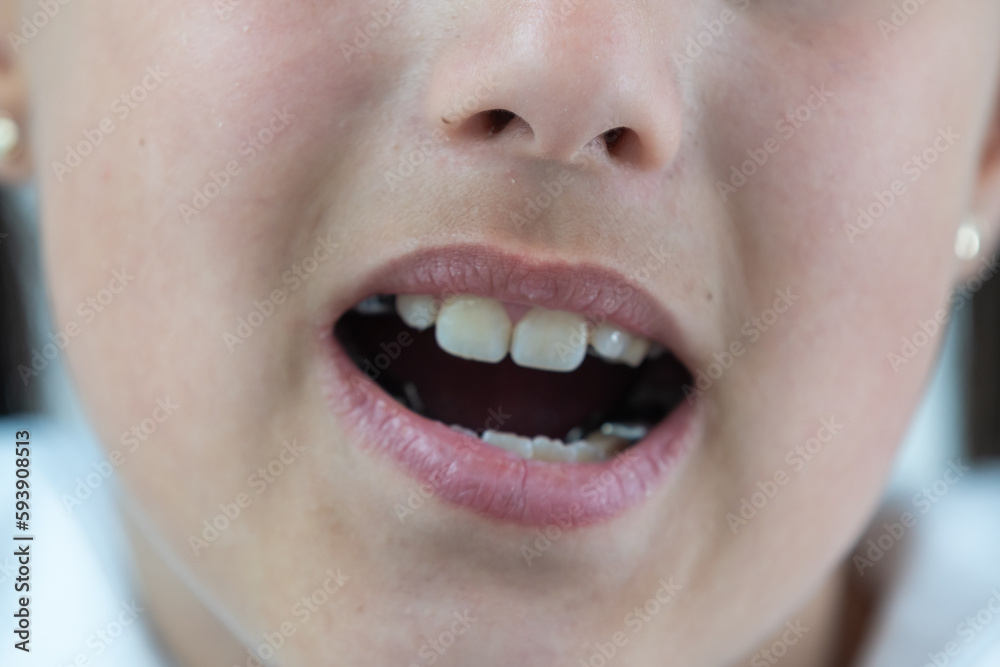 a little girl with a shifted dentition demonstrates her teeth a little girl with a shifted dentition demonstrates her teeth