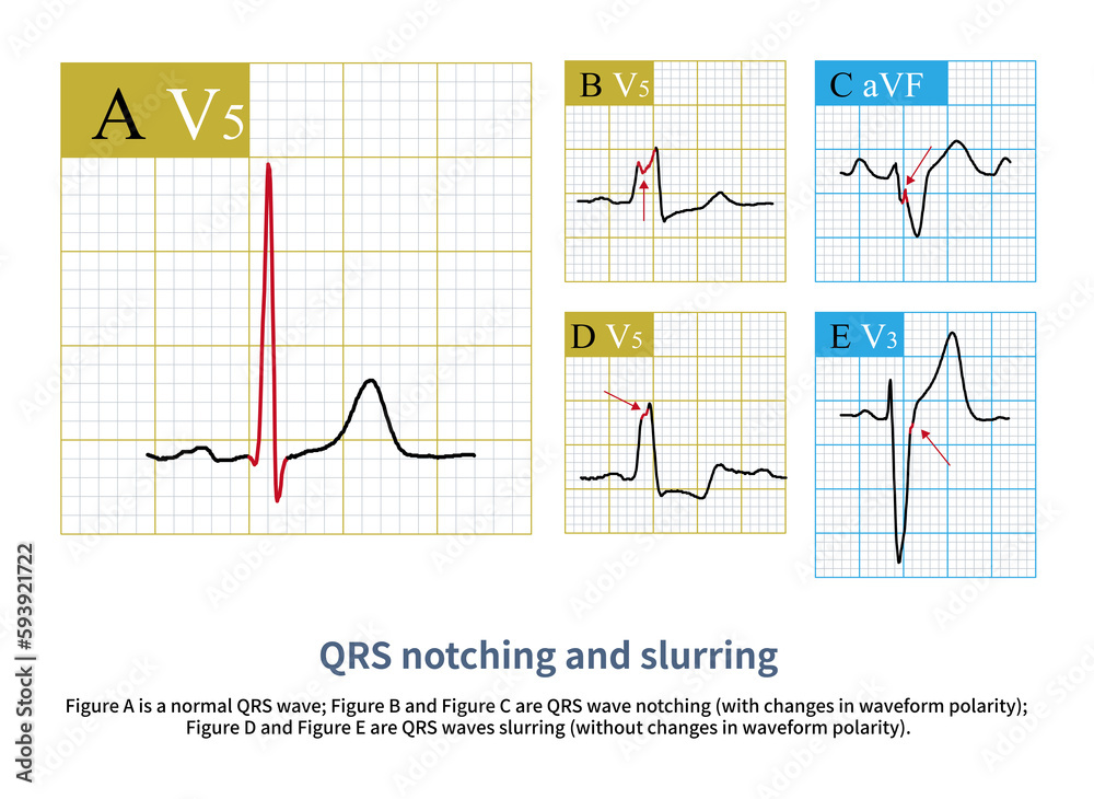 Normal ventricular depolarization produces smooth and sharp QRS waves; when local ventricular muscle depolarization is impaired, QRS notching and slurring are produced.