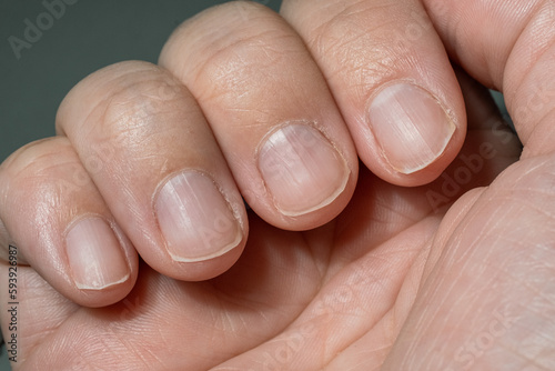 Overgrown unkempt nails on a woman's hand with a dry cuticle, requiring manicure care. Close-up, macro.