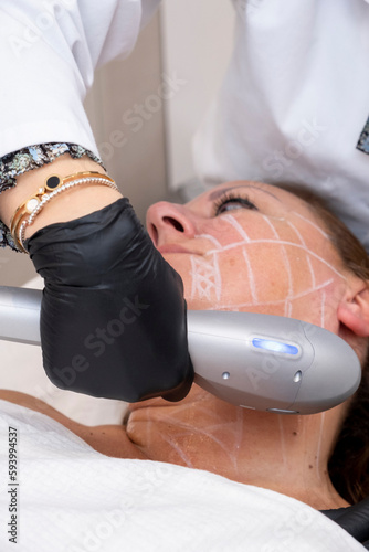 Skin tightening on a woman's face by ultrasound treatment in the beauty clinic