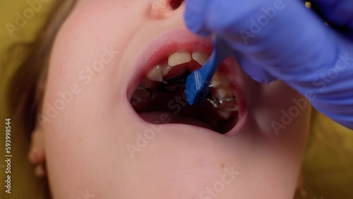 Setup orthodontic plate in child mouth. Mechanism to straight teeth. Dentist in gloves. Healthcare and medicine concept. Childhood problems with tooth health. Dentist in work. Marco rosa key part