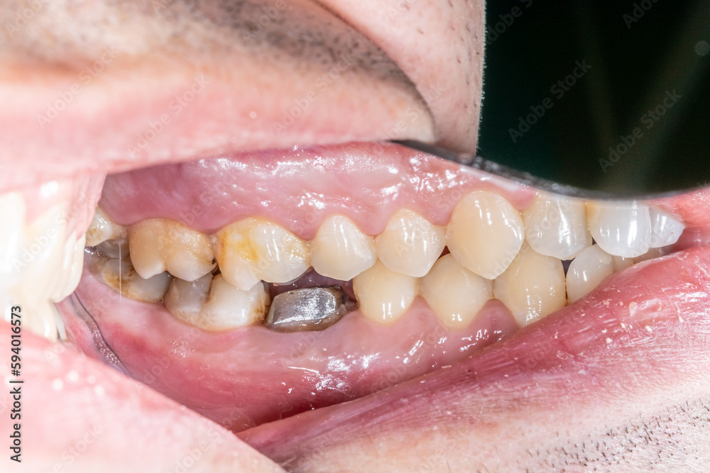 Lateral view of dental arches in occlusion with a lower molar decayed and destroyed crown, restored with a prosthodontic metallic post and core build-up. Lateral mirror indirect view 