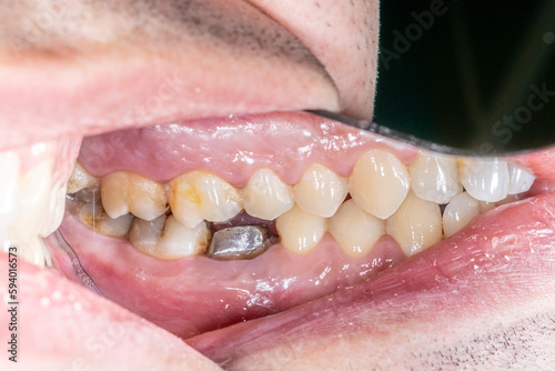 Lateral view of dental arches in occlusion with a lower molar decayed and destroyed crown, restored with a prosthodontic metallic post and core build-up. Lateral mirror indirect view 