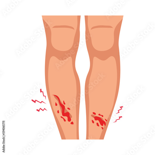 Legs Wounds Illustration