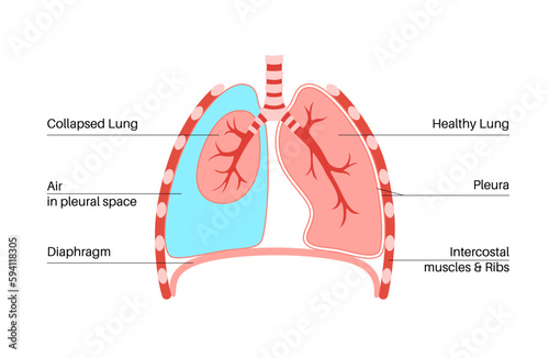 Pneumothorax anatomical poster