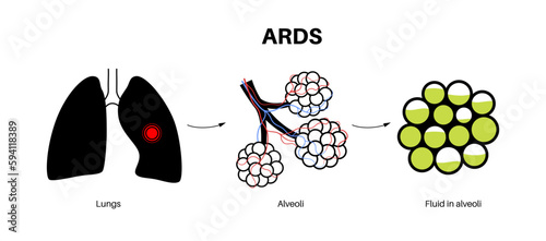 ARDS anatomical poster