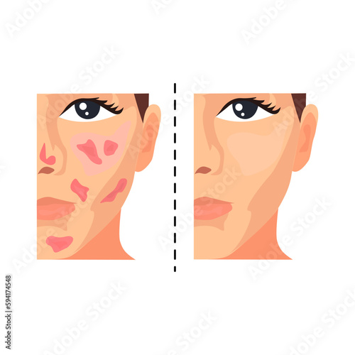 Acne removal illustration in color cartoon style. Editable vector graphic design.
