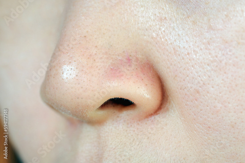 Women with oily skin and enlarged pores and clogged acne. Problems of skin care. photo
