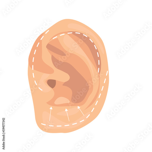 Otoplasty illustration in color cartoon style. Editable vector graphic design.