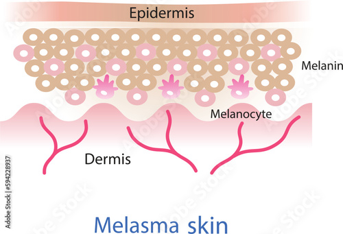  The mechanism of melasma skin vector. Beauty skin care concept illustration.