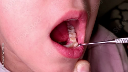 Pediatric dentist examines a loose milk tooth in a child	
