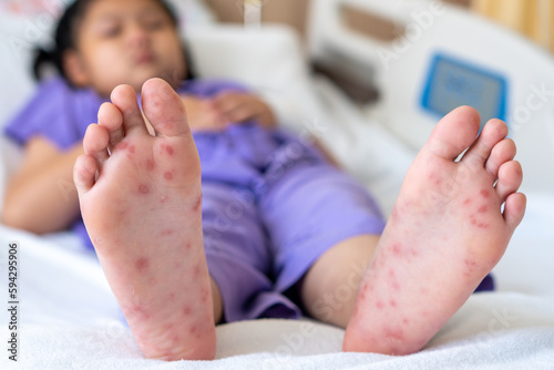 Enterovirus foot red spots blisters on the skin of on the body of a purple uniform child virus on bed at hospital