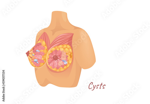 Concept Mammary glands female breast with cysts. The illustration is a flat design vector of the anatomy of the female breast, showcasing a cartoon depiction of cysts. Vector illustration.