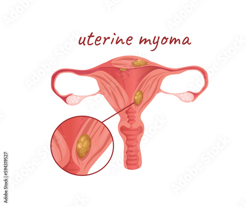 Concept Female anatomy uterus with myoma. This illustration is a flat vector design of the female reproductive system, focusing on the uterus with myomas. Vector illustration.