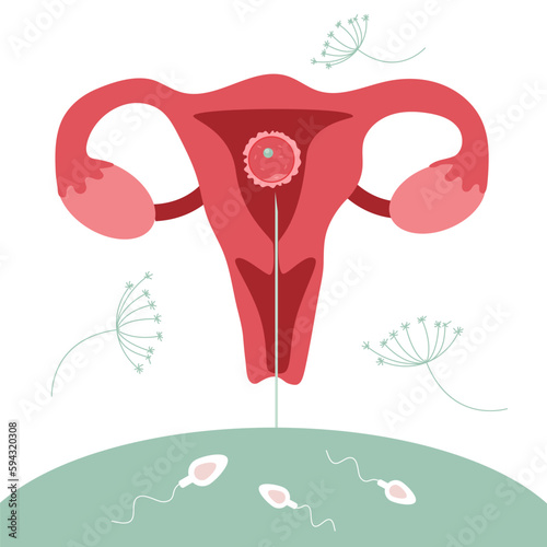 The illustrarion with procedureinsemination Intrauterine, IUI. The planing pregnant Illustration with egg cell, sperm cell good for poster medical clinic.