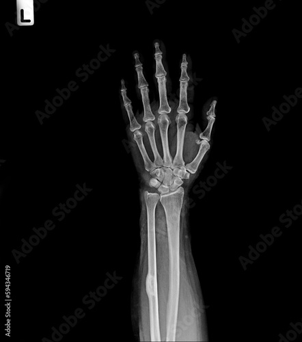 Film x-ray hand AP show normal human hand