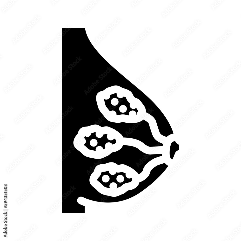 ductal breast cancer glyph icon vector illustration ductal breast cancer glyph icon vector illustration