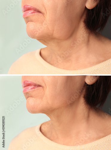 Double chin problem. Collage with photos of mature woman before and after skin tightening treatments on light grey background, closeup