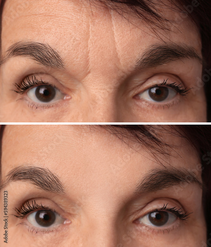 Fotografie, Obraz Mature woman before and after skin tightening treatments