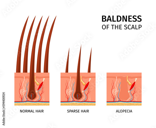 Scalp Baldness Structure Composition