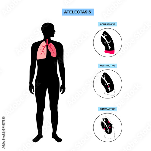Atelectasis medical poster