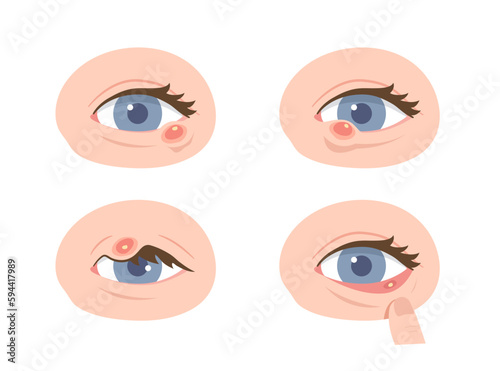 Set of various locations of stye eye. Concept of Hordeolum, infectious eye, Ophthalmology, medical illustration, health care. Flat vector illustration.