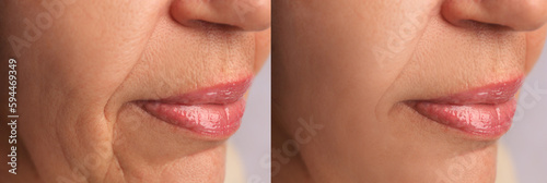 Mature woman before and after skin tightening treatments. Collage with photos, closeup
