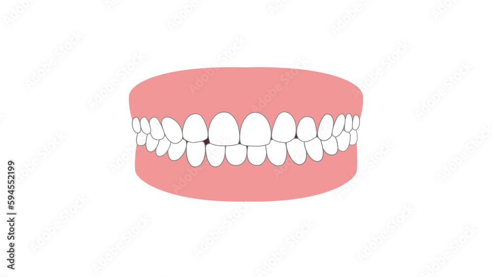 Obraz premium 歯並び（かみ合わせ）が悪い歯（背景透過）のイラスト