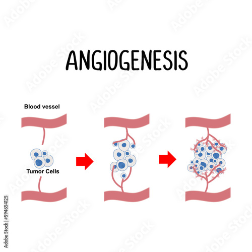 Angiogenesis: The formation of new blood vessels, often stimulated by cancer cells to ensure a sufficient supply of nutrients for tumor growth. photo