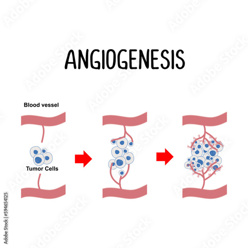Angiogenesis: The formation of new blood vessels, often stimulated by cancer cells to ensure a sufficient supply of nutrients for tumor growth.