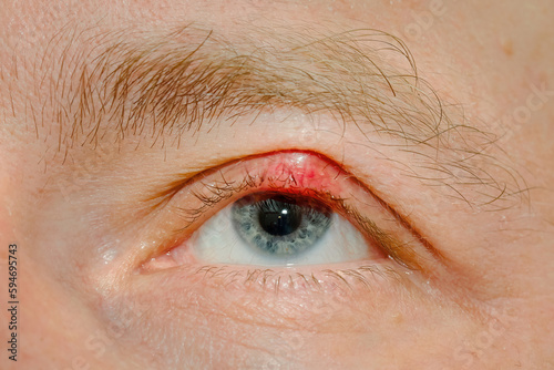 Eye sick, eyelid sick. Demodicosis mite diseas, demodex. Chalazion on eyelid. Eye treatment. Inflammation of eyelashes hair follicle, Demodex folliculitis. Scales on skin and eyelashes, eczema