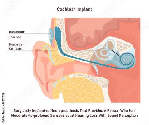 Hearing aid or cochlear implant. Surgically implanted neuroprosthesis photo