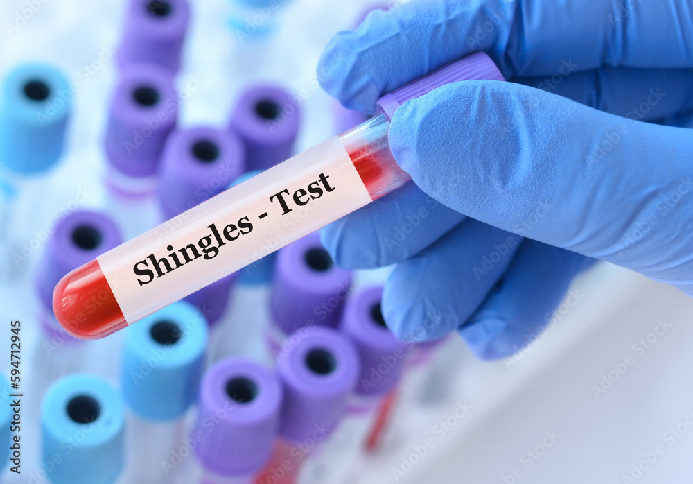 Naklejka premium Doctor holding a test blood sample tube with Shingles test on the background of medical test tubes with analyzes