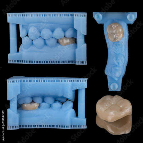 Resin model of upper and lower tooth with lower most posterior tooth all ceramic dental crown from inside and outside view and from top view isolated on black background