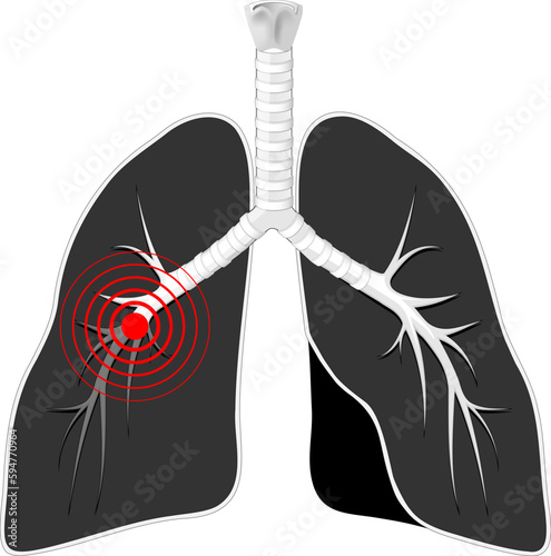 Lungs disease. Black lungs with bronchi on white background.