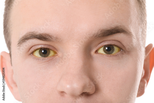 Man with yellow eyes on white background, closeup. Symptom of hepatitis