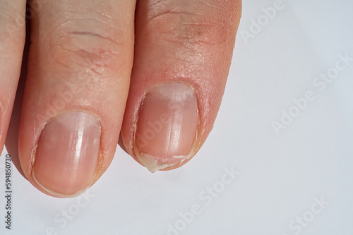 Close-up of brittle nails on woman s hands. Female broken fingernail. weak sore nails.